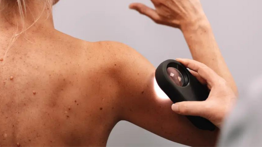 Solbari blog: checking your moles & why you should do it now