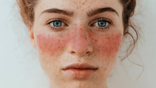 Solbari blog: What is lupus?