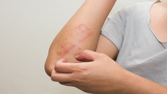 Solbari blog: What is psoriasis?