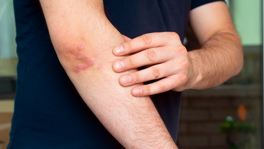 Solbari helping people with Psoriasis