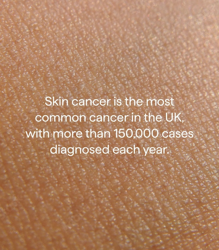 150,000 skin cancer cases per year